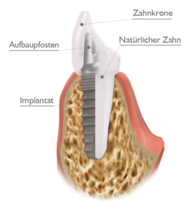 Ein eingesetztes LASAK Implantat