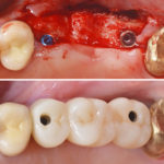 Zur Augmentation wurden Eigenknochen mit Knochenersatzmaterial PORESORB-TCP und einer Kollagenemembran Collagene AT verwendet; nach Ausheilung wurden zwei Implantate BioniQ Plus eingesetzt. Die angestrahlten Abutments wurden intraoral verschaubt und danach die Brücke verklebt.