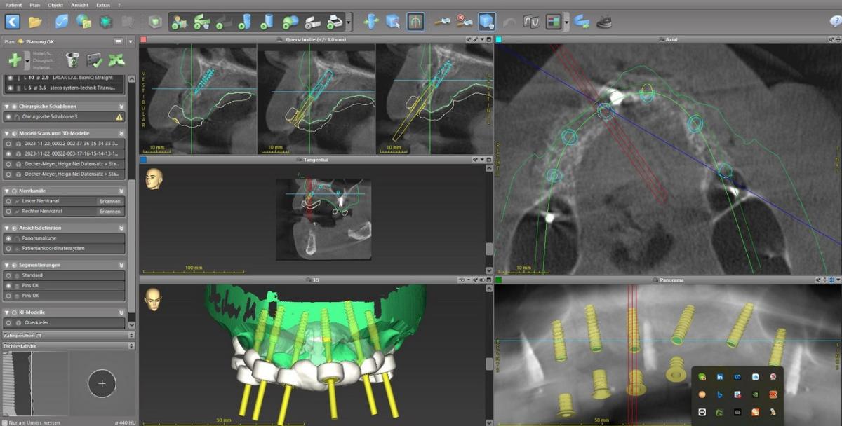 3D-Planung im Oberkiefer 