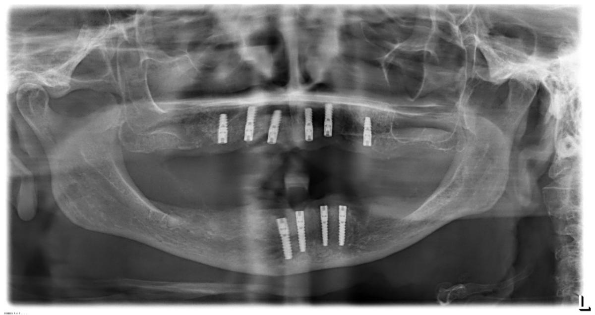 OPG nach Einsetzen von allen zehn Implantaten BioniQ