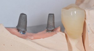 Die beiden vor dem intraoralen Zementieren rau gestrahlten Abutments.